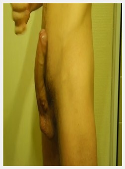 Gay 包皮, 非常瘦小